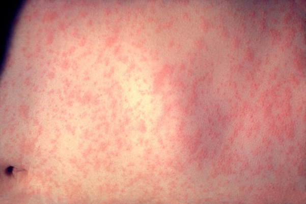 One symptom of measles is a red rash all over the body.Photo from Wikimedia Commons